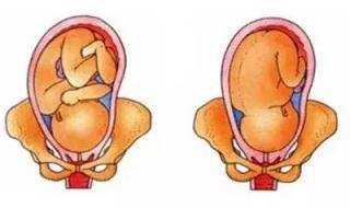 胎位不正怎么纠正