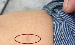 艾滋病的早期症状图片 艾滋病的早期症状图片